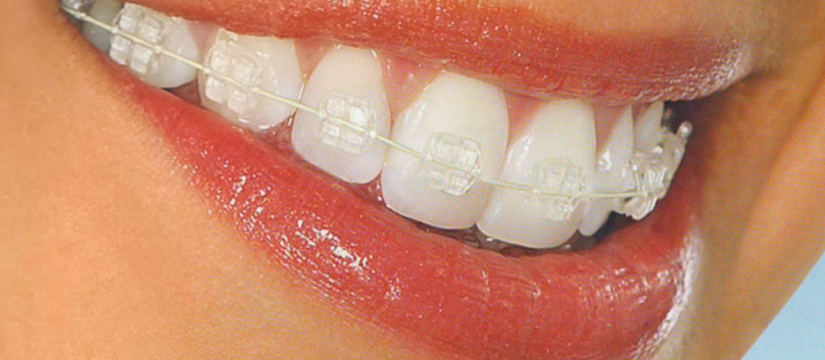Clear aligners on a smile, Invisalign cost guide Glenmore Park