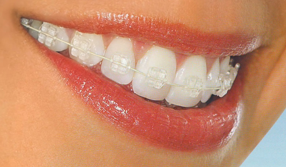 Clear aligners on a smile, Invisalign cost guide Glenmore Park