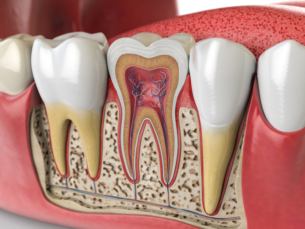 root canal