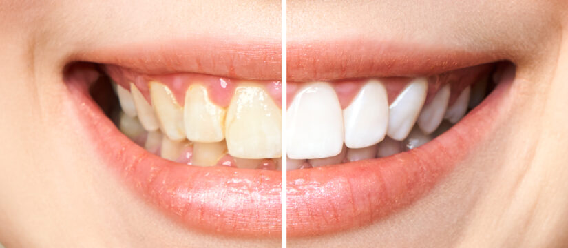 teeth whitening