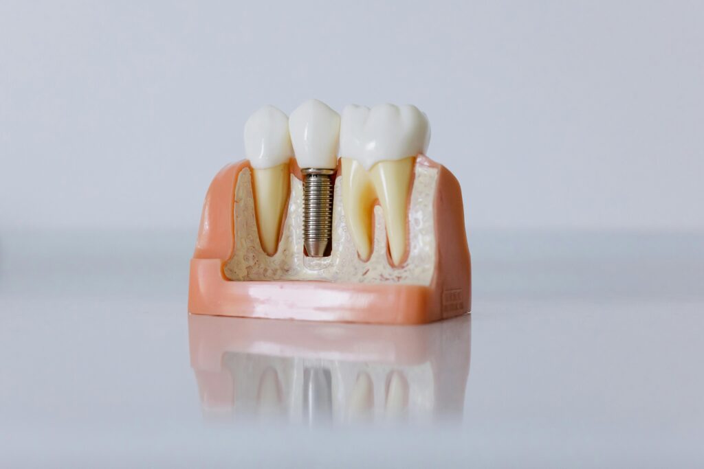 Dental implant vs bridge: implant model