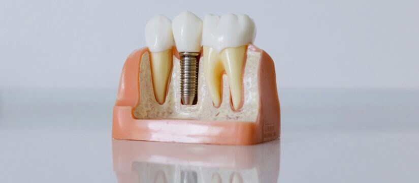 Dental implant model showing a titanium implant in the jaw - dental implants Glenmore Park